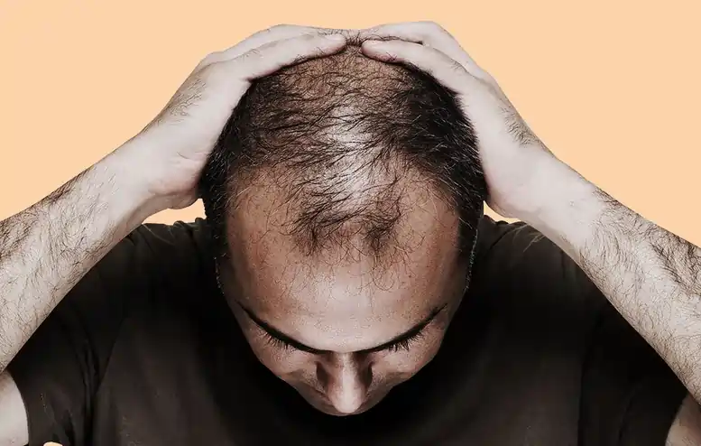 Saç tökülməsinin səbəbləri və müalicəsi