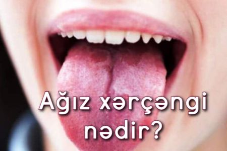 Ağız xərçəngi nədir?