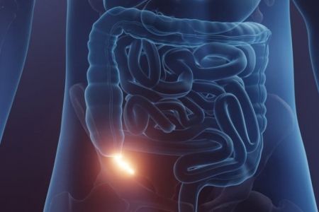 Appendisitin simptomları hansılardır? Apqendisit ağrısı və əlamətləri