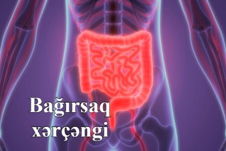 Bağırsaq xərçənginin əlamətləri hansılardır?