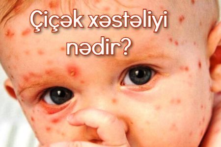 Çiçək xəstəliyi nədir, necə yayılır? Simptomları və müalicəsi