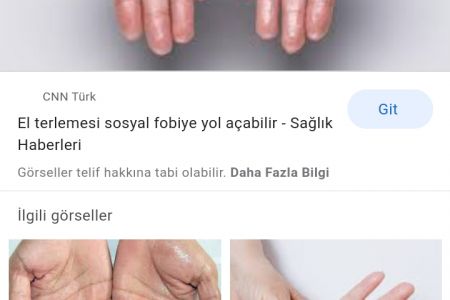Əllərin tərləməsinin qarşısın almaq üçün nə etməli