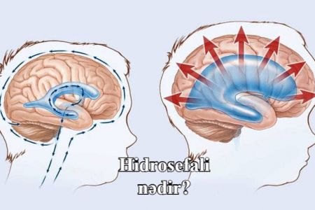 Hidrosefaliya nədir? Hidrosefaliyanın simptomları və müalicə metodları