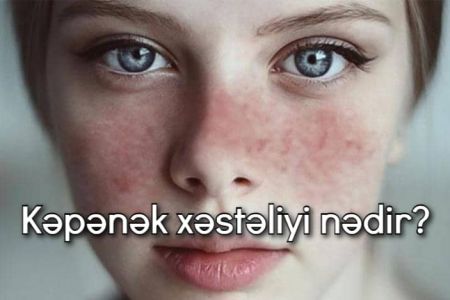 Kəpənək xəstəliyi (Lupus) nədir?