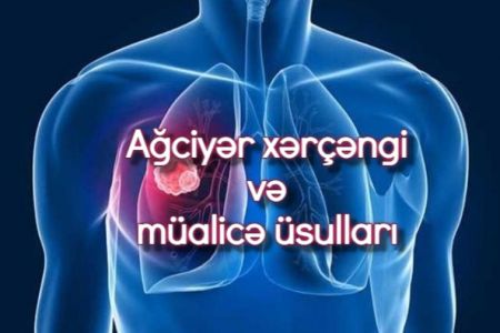 Kiçik hüceyrəli ağciyər xərçəngi nədir? Necə diaqnoz qoyulur? Müalicə necədir?