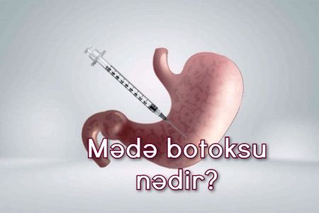 Mədə botoksu haqqında 5 sual və 5 cavab