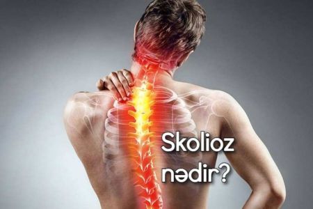 Skolioz (onurğa əyriliyi) nədir?