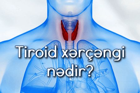 Tiroid (qalxanabənzər vəzi) xərçəngi nədir? Səbəbləri, simptomları və müalicəsi