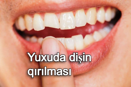 Yuxuda dişin qırılması nə anlam verir?