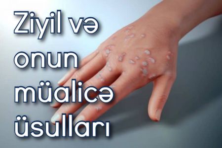 Ziyil nədən yaranır və necə müalicə olunur?