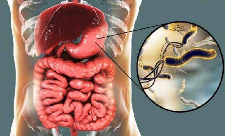 Helicobacter Pylori simptomları