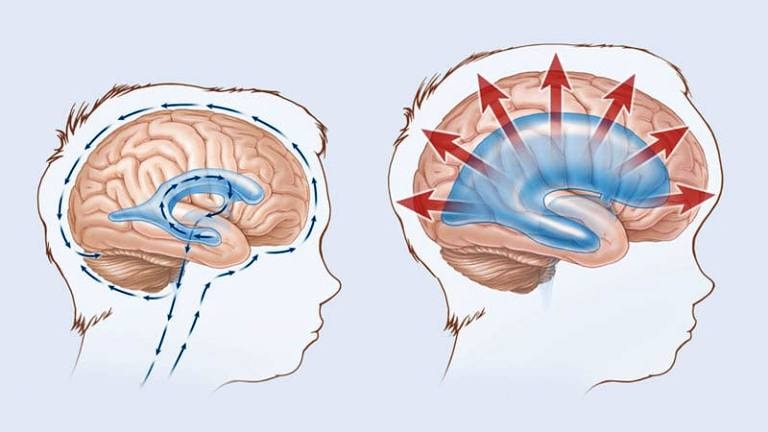 Hidrosefaliya niyə yaranır?